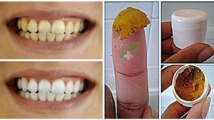 Diş Beyazlatmada Mucize Yöntem – Herkes Sırrını Soracak